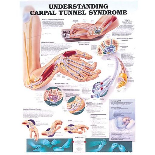 Picture of UNDERSTANDING CARPAL TUNNEL