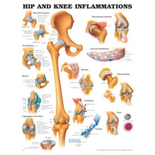 Picture of HIP AND KNEE INFLAMMATIONS CHART