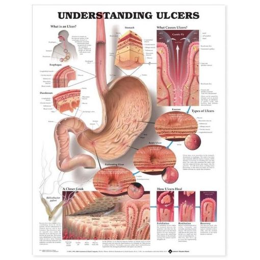 Picture of UNDERSTANDING ULCERS CHART